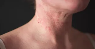 Eczema Relief Made Gentle with Aerolase Laser Treatments