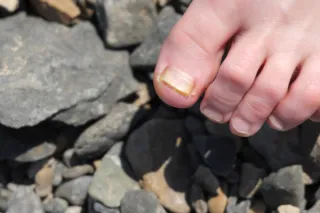 How to Prevent Fungal Nail Infections: Tips for Keeping Your Nails Healthy