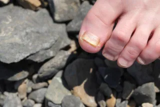 Why Do Fungal Nail Infections Take So Long to Heal?