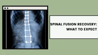 Spinal Fusion Recovery: What to Expect | Strength & Spine