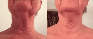 Neck Wrinkles