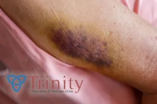 Chronic Wounds 101: Causes, Prevention, and Treatment Options in Kansas City