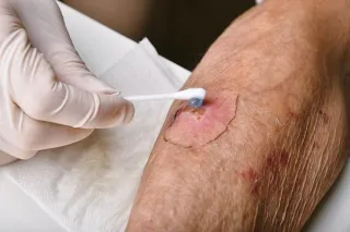 How to Recognize Wound Infections Early: Signs to Watch For Kansas CIty