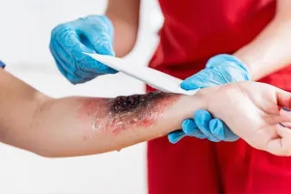 Healing Burns: What Kansas City Residents Need to Know About Burn Wound Recovery