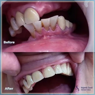 The Benefits of Dental Implants: Durability, Natural Appearance, and Long-Term Benefits