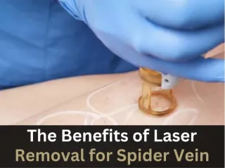 The Benefits of Laser Removal for Spider Vein