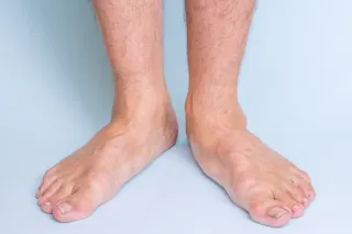 The Impact of Flat Feet on Heel Pain: How Poor Foot Structure Affects Your Health
