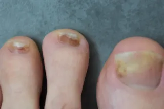 Damaged Toenails? How Toenail Reconstruction Can Give You Back Your Confidence