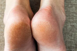 How to Get Summer-Ready Feet Without the Flaky Disasters