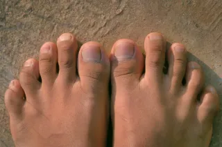 5 Things Your Toenails Say About Your Health
