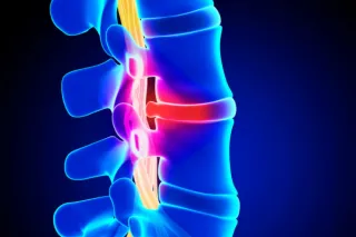 Finding Relief from Pinched Nerve Pain in Lawrenceville