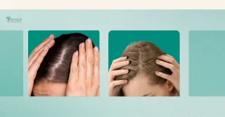 Hair Thinning in Women: 3 Overlooked Causes