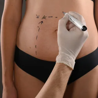 Understanding Fibrosis: Prevention and Treatment After Cosmetic Surgery