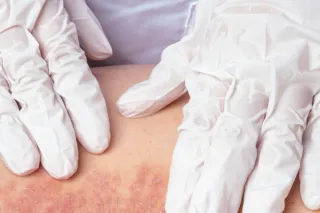 Who Should Handle Musculoskeletal Symptoms in Psoriasis Patients: Dermatologists or Rheumatologists?