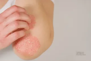 Understanding the Different Faces of Psoriatic Arthritis: New Study Reveals 3 Patient Clusters
