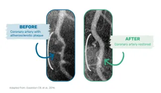 Lifestyle Changes Reverses Coronary Atherosclerosis