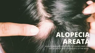 Alopecia Areata and Stress