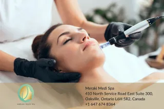 Microneedling in Oakville: The Secret to Radiant, Youthful Skin