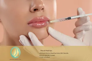 Lip Filler Treatments in Oakville: Enhance Your Natural Beauty with Meraki Medi Spa