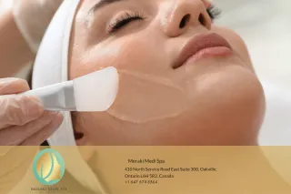 Top 5 Benefits of Chemical Peels for Glowing Skin in Oakville