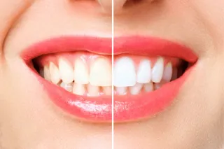Dentist-Approved: Get a Dazzling Smile with the Latest Teeth Whitening Breakthroughs In San Jose