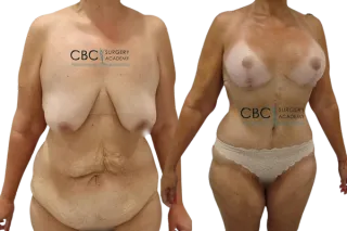 🩺 Transformación tras una gran pérdida de peso: mastopexia, abdominoplastia y liposucción integral en CBC