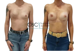 🩺Reconstrucción mamaria tras mastectomía: más que devolver la forma, devolver confianza