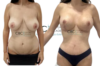 🩺Recuperación avanzada tras Mommy Makeover