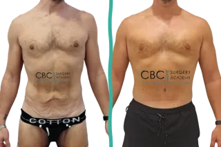 🩺 Abdominoplastia tras pérdida masiva de peso: planificación, evolución y resultado final