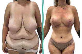 🩺 Transformación después de tres embarazos: abdominoplastia y mastopexia en T invertida con resultados naturales