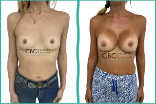 💎 Aumento mamario por surco submamario: técnica, evolución y claves formativas CBC