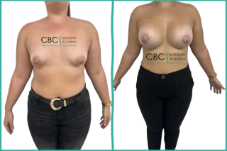 ✨ Mastopexia periareolar con implantes anatómicos: técnica, evolución y aprendizaje quirúrgico CBC