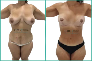 🩺De la planificación integral al resultado armónico: un caso de Mommy Makeover en CBC