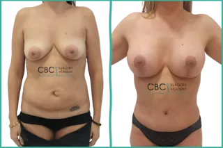 💎 Cirugía combinada de mastopexia y abdominoplastia: planificación integral y resultados con metodología CBC