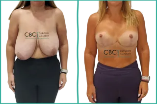 🔷 Reducción mamaria con implantes e injerto de areola: control del volumen y naturalidad con técnica CBC