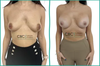 💎Mastopexia periareolar con implantes redondos | Caso clínico CBC Academy