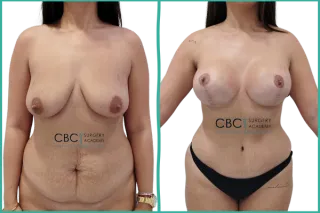 💎 Cirugía corporal combinada: mastopexia con implantes y abdominoplastia con lipoescultura