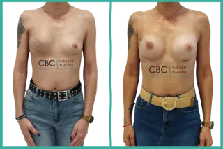 🩺Reconstrucción mamaria tras mastectomía: más que devolver la forma, devolver confianza