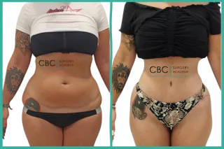 💎 Abdominoplastia con lipoescultura 360° en paciente joven: planificación, técnica y resultado