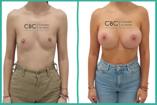 ⭐ Caso clínico: Corrección de asimetría mamaria con mastopexia periareolar compleja + implantes 812N 400cc