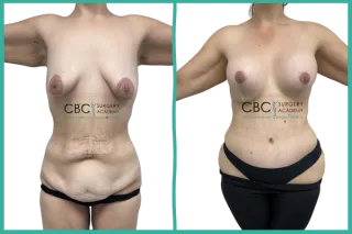 ⭐ Caso clínico: Reducción mamaria con implantes 812N 500cc + abdominoplastia tras pérdida masiva de peso (–60 kg)