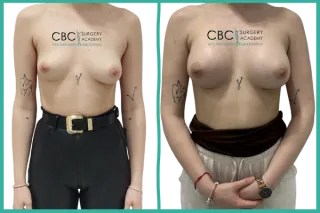 ⭐Aumento Mamario Simple con Implantes Redondos – Técnica, Proceso y Evolución