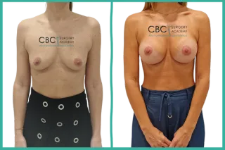 ⭐ Mastopexia Periareolar con Implantes Motiva ERSC 300Q