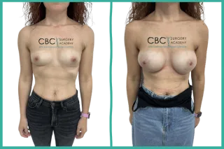 👉Aumento de Pecho con Implantes Motiva ERSF 295Q