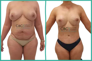Abdominoplastia con liposucción y reducción mamaria en Pacientes con IMC Elevado y el Rol Crucial de la Nutrición.