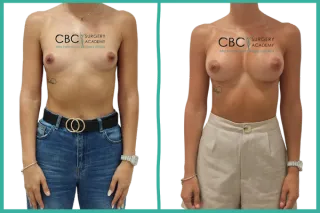 📝 Aumento Mamario: Técnica, Implantes Ergonómicos y Gestión del Tabaquismo