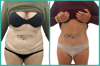 📚 Evolución clínica real tras abdominoplastia y liposucción 360º