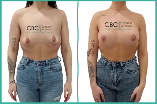 📚Mastopexia periareolar con implantes