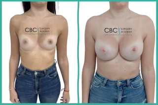 👉Caso clínico: Aumento mamario simple con implantes ergonómicos ERSC 350cc