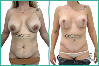 ⭐Caso clínico: Abdominoplastia + liposucción de abdomen y cintura + Mastopexia en T invertida con recambio de implantes